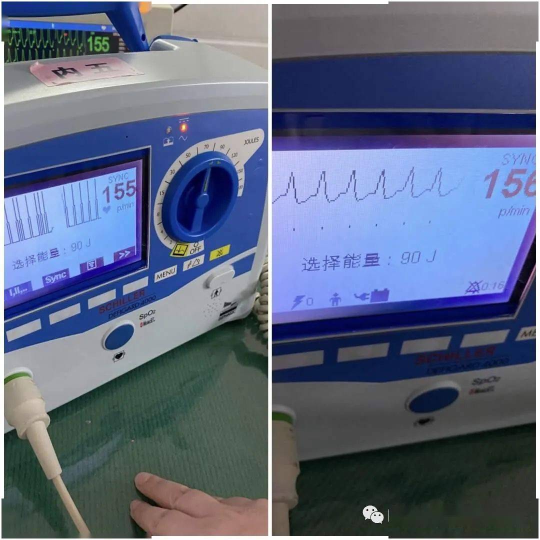 阵发性室性心动过_阵发性房性心动_阵发性室上性心动过速的治疗