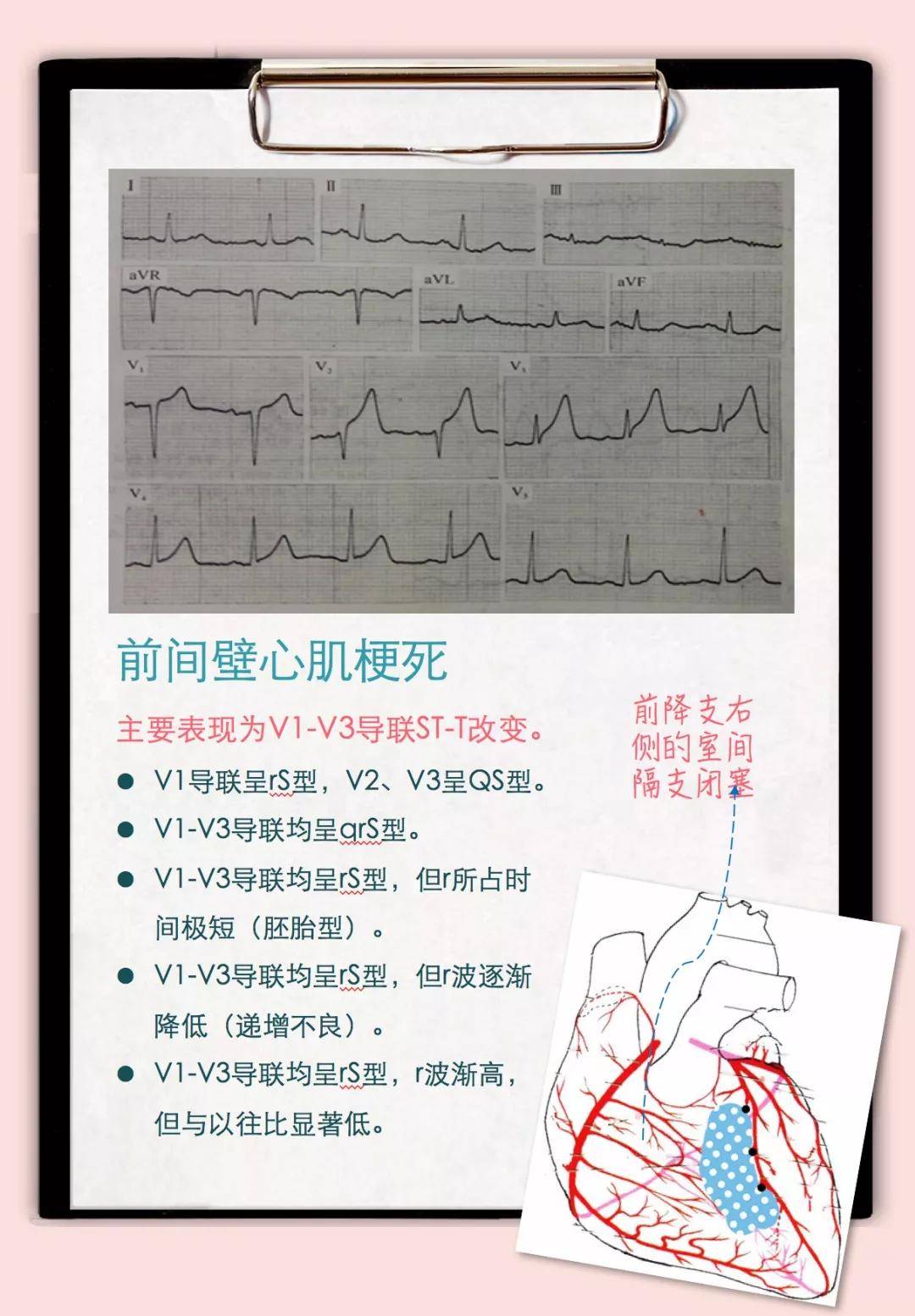 ST段抬高：正常人也可能有心脏问题